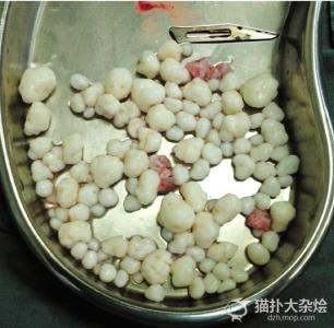 去 瘤子的药方 30岁小伙肩膀取出上百颗瘤子 装满半个铁盘