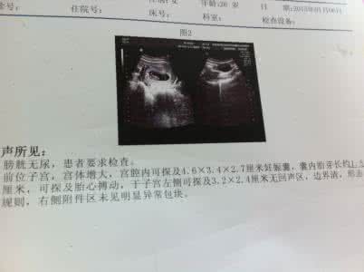 怀孕50天胎停育的症状 怀孕50天的症状