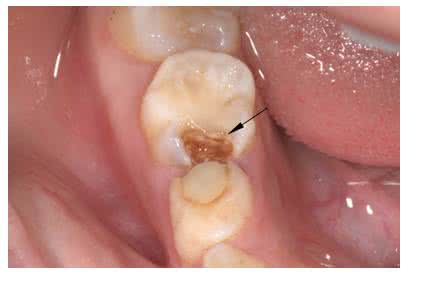 治虫牙的偏方最快方法 治虫牙的方法都有哪些呢?