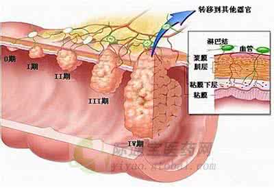 如何预防大肠癌 大肠癌严重吗 如何预防及治疗大肠癌
