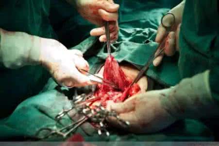 100张剖腹产过程照片 剖腹产的100张照片，太震撼！！