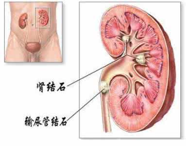 肾结石钝痛 肾结石的症状有哪些？多出现腹部钝痛