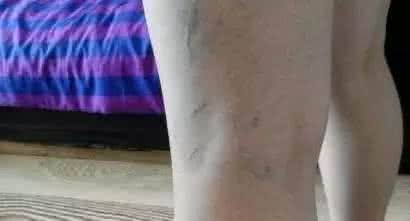 手背青筋凸起小妙招 “青筋” 凸起,意味着什么?99%的人都不知道