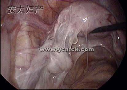宫外孕微创手术后怀孕 疑问:做过宫外孕手术后还能怀孕吗?