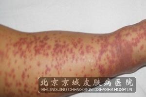 中医治疗过敏性紫癜 过敏性紫癜肾炎 中医治疗过敏性紫癜肾炎
