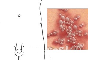 男性生殖器疱疹早期 男性生殖器疱疹 男性生殖器由哪些部分组成