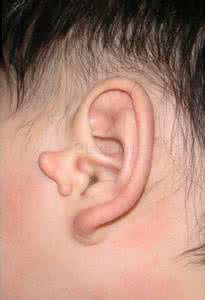 小耳畸形整形 小耳畸形 小耳畸形要如何整形