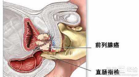 男性前列腺癌 男性经常射精可以有效预防前列腺癌