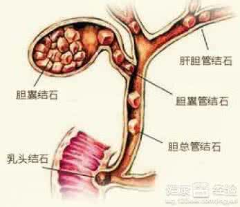 胆结石的症状 胆结石的症状 五大症状要注意