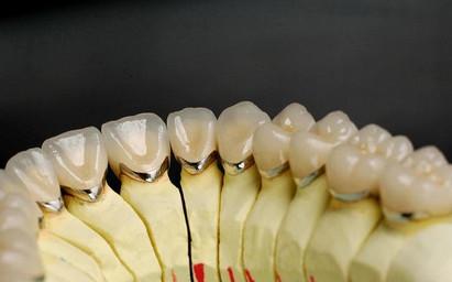 纯钛合金烤瓷牙价格 纯钛烤瓷牙价格 纯钛合金烤瓷牙