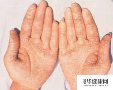 手足皲裂怎么治 秋冬手足皲裂怎么办