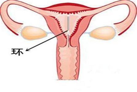 取环后腰疼怎么回事 取环半年不怀孕怎么回事呢？