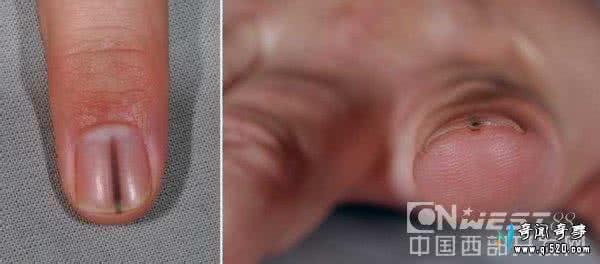 指甲有裂缝 罕见病例：看似指甲开裂，实际上是肿瘤