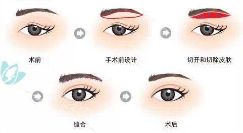 鼻翼整形手术方式 鼻翼整形手术方式 男人整形要做哪些手术方式