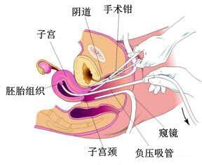 微创无痛人流手术时间 微创人流手术最佳时间分析