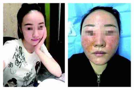 美容要花多少钱 花7万美容惨变“大小脸”
