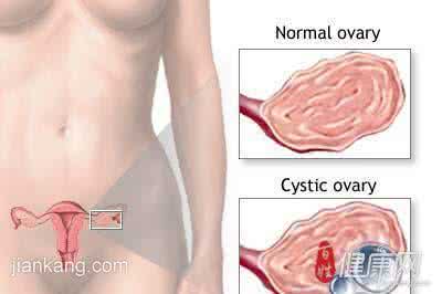 卵巢囊肿的危害 卵巢囊肿的危害 黑眼圈的危害 突然出现黑眼圈要注意卵巢囊肿