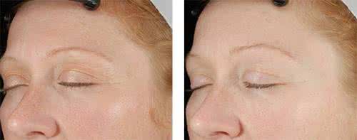 抬头纹除皱 抬头纹 抬头纹除皱