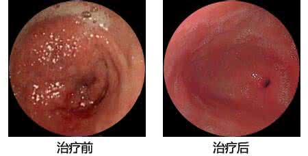 糜烂性胃炎能喝蜂蜜吗 糜烂性胃炎能喝酸奶吗