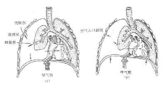 张力性气胸 张力性气胸 张力性气胸的症状与护理