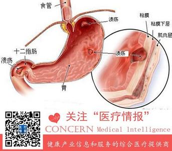 胃病一般几年转为癌变 胃病一般几年转为癌变 发现这个信号胃病要癌变