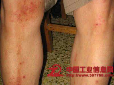 过敏性紫癜是什么症状 过敏性紫癜严重吗 发病症状是什么