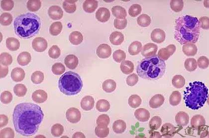 贫血会引起白细胞低吗 白细胞低 引起白细胞低的原因有哪些