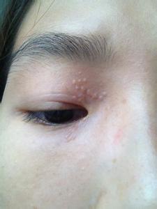 哪个医院治扁平疣 治疗扁平疣的医院哪个好