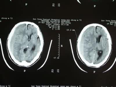 慢性硬膜下血肿 图解：慢性硬膜下血肿  都是“月亮”惹的祸