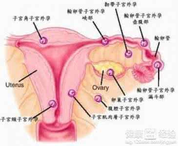 宫外孕有哪些现象 宫外孕有哪些症状