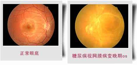 糖尿病视网膜病变治疗 糖尿病眼底病变怎么治 糖尿病视网膜病变的治疗