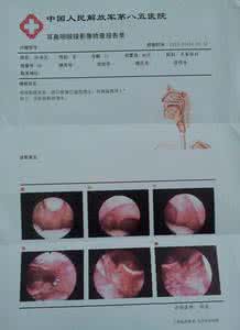 慢性咽喉炎治疗方法 慢性咽喉炎 六种方法有效预防慢性咽喉炎