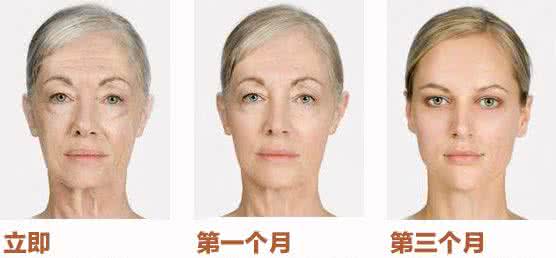 哪里做电波拉皮效果好 电波拉皮效果 电波拉皮的效果哪个年龄段做最好