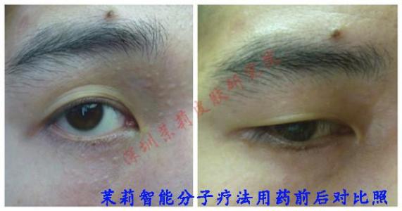 汗管瘤的治疗方法 汗管瘤的治疗方法 哪些方法可以治疗