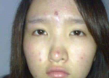 痘痘咨询专家 火痘痘抹肤专家行吗？