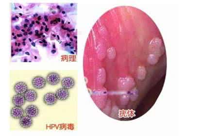 尖锐湿疣的传播方式 病得疣会有哪些传播方式