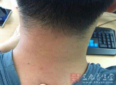 腹股沟淋巴结肿大 腹股沟淋巴结肿大 这种病症如何预防