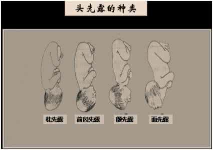 带有胎儿头的骨盆模型 胎儿什么时候入骨盆 带有胎儿头的骨盆模型-上海宸博