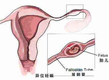 左侧排卵右侧宫外孕 左侧排卵右侧宫外孕 宫外孕术后不排卵