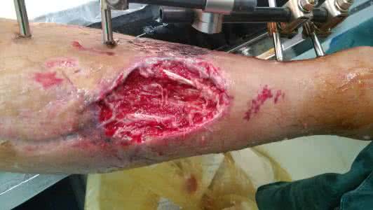 左腿比右腿粗 左腿被蛇咬 右腿坏死没了