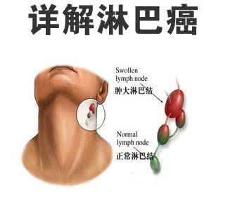 淋巴瘤早期症状 淋巴瘤早期症状 积极治疗淋巴瘤