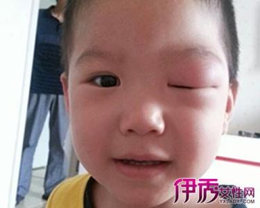 眼皮被蚊子咬快速消肿 蚊子咬眼皮快速消肿 【蚊子咬了怎么消肿】被蚊子咬最快速有效的消肿方法