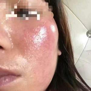 脸部激素性皮炎 严重激素性皮炎怎么办 激素脸为何越治反而越严重了?