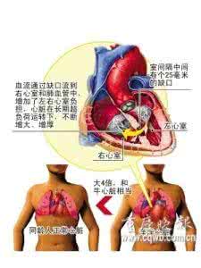 心脏扩大如何治疗 心脏扩大 如何治疗心脏扩大