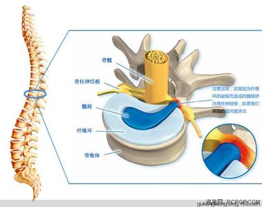 椎间盘突出自我治疗 椎间盘突出自我治疗 在家治疗椎间盘突出