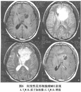 星形细胞瘤能活几年 星形细胞瘤 如何预防星形细胞瘤