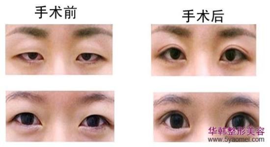 做埋线双眼皮多少钱 做埋线双眼皮多少钱 埋线双眼皮多少钱