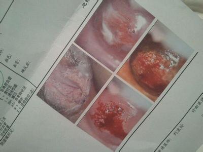 治疗宫颈糜烂的药物 治疗宫颈糜烂的药 治疗宫颈糜烂的药物