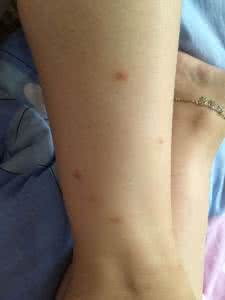 蚊子咬了怎么消红点 蚊子咬的红点怎么消 被蚊子咬了起红点红包怎么办