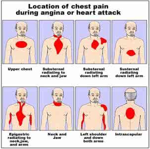 心绞痛的症状是什么 心绞痛症状是什么 心绞痛的各类症状